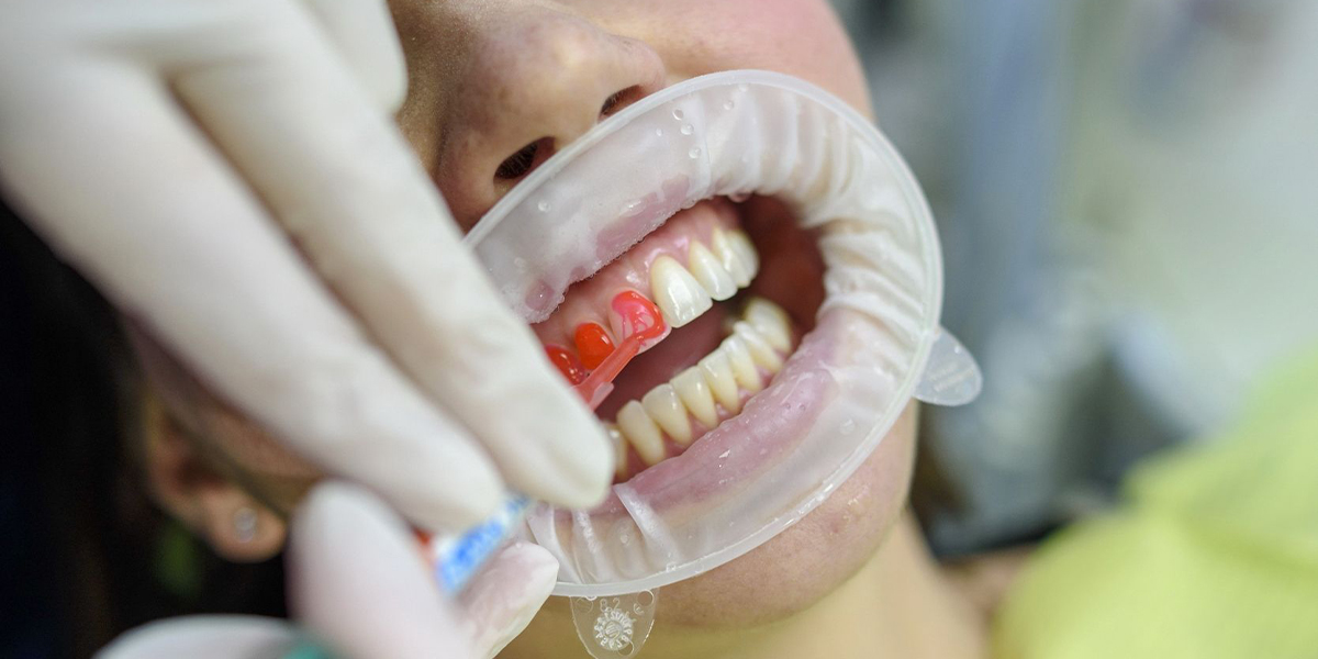 studio-dentistico-marchesini-sbiancamento-dentale
